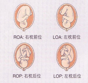 什么是胎位loa?胎位loa是男孩还是女孩