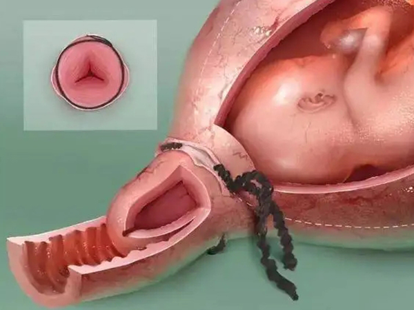 宫颈环扎术动画图片