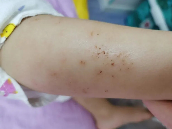 儿童冬季干性湿疹真实图分享,胳膊,后背,小腿对比看看