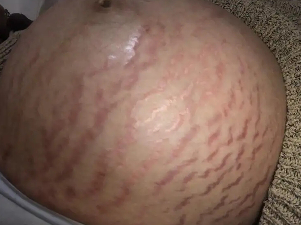 产后各种妊娠纹真实图片分享,腿上,肚皮凸起发红很常见