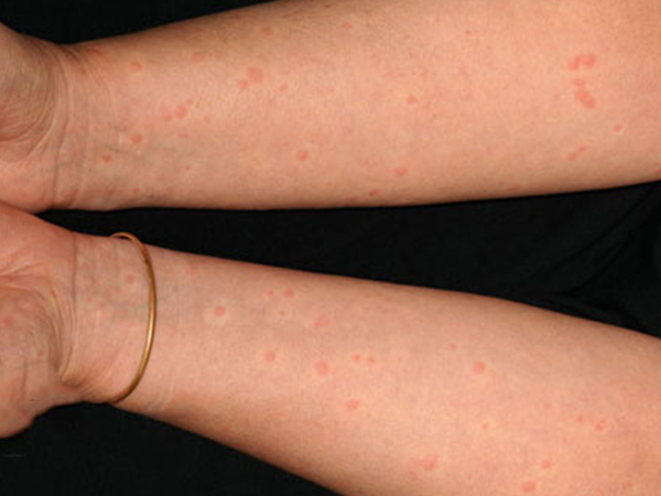 荨麻疹的早期症状图片图片